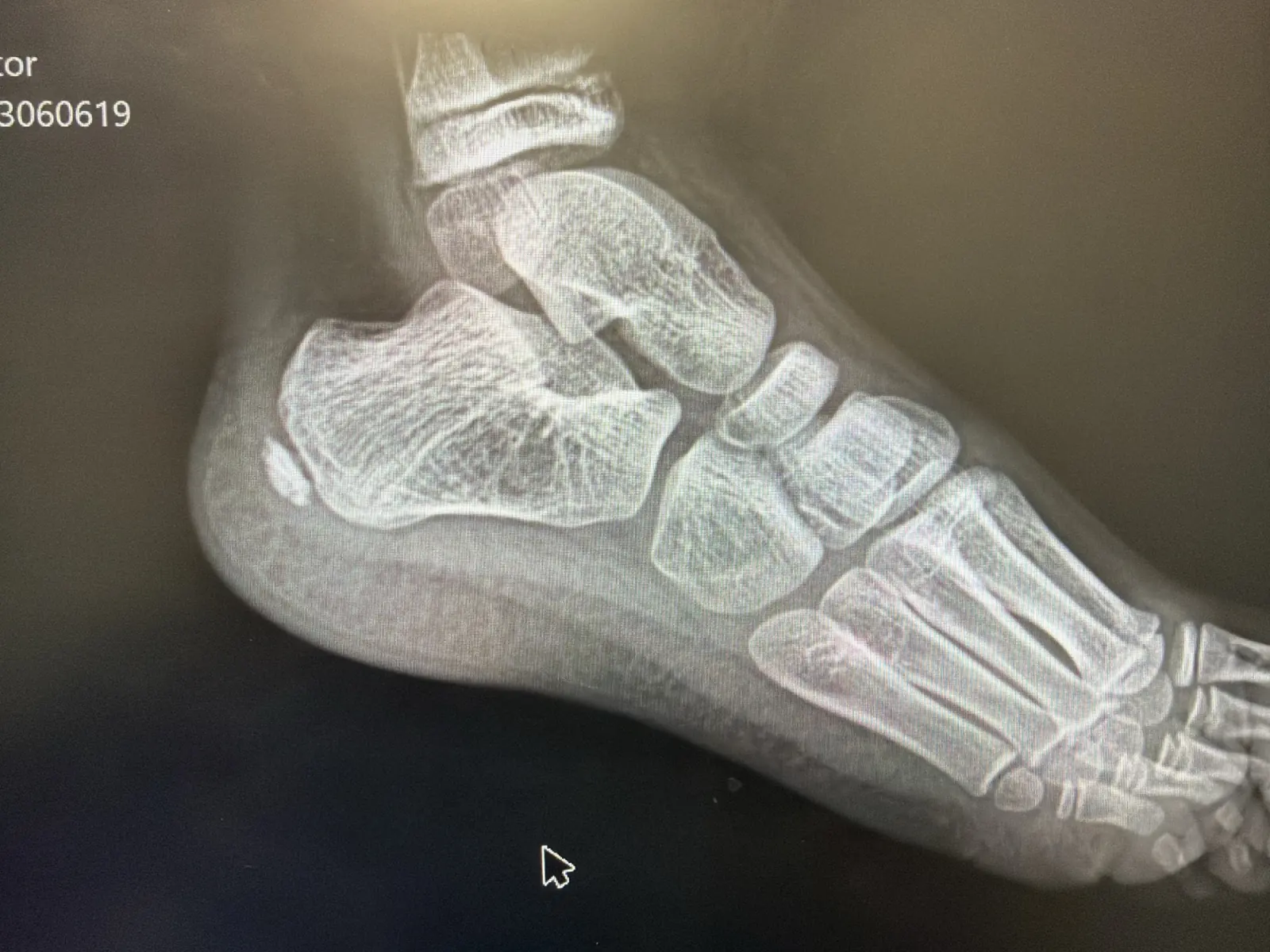Digital foot X-ray at Lakeside