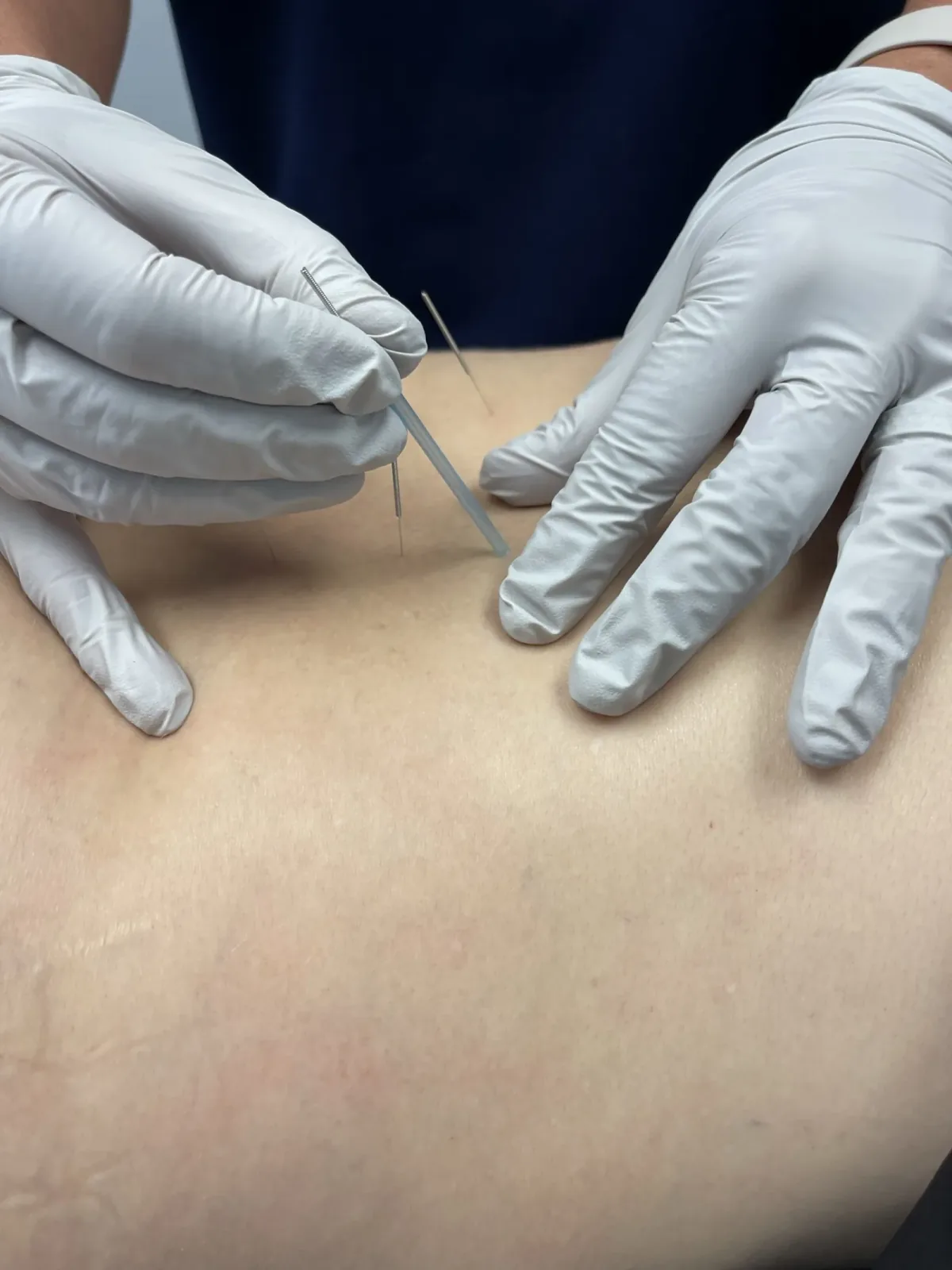 Dry needling at Lakeside